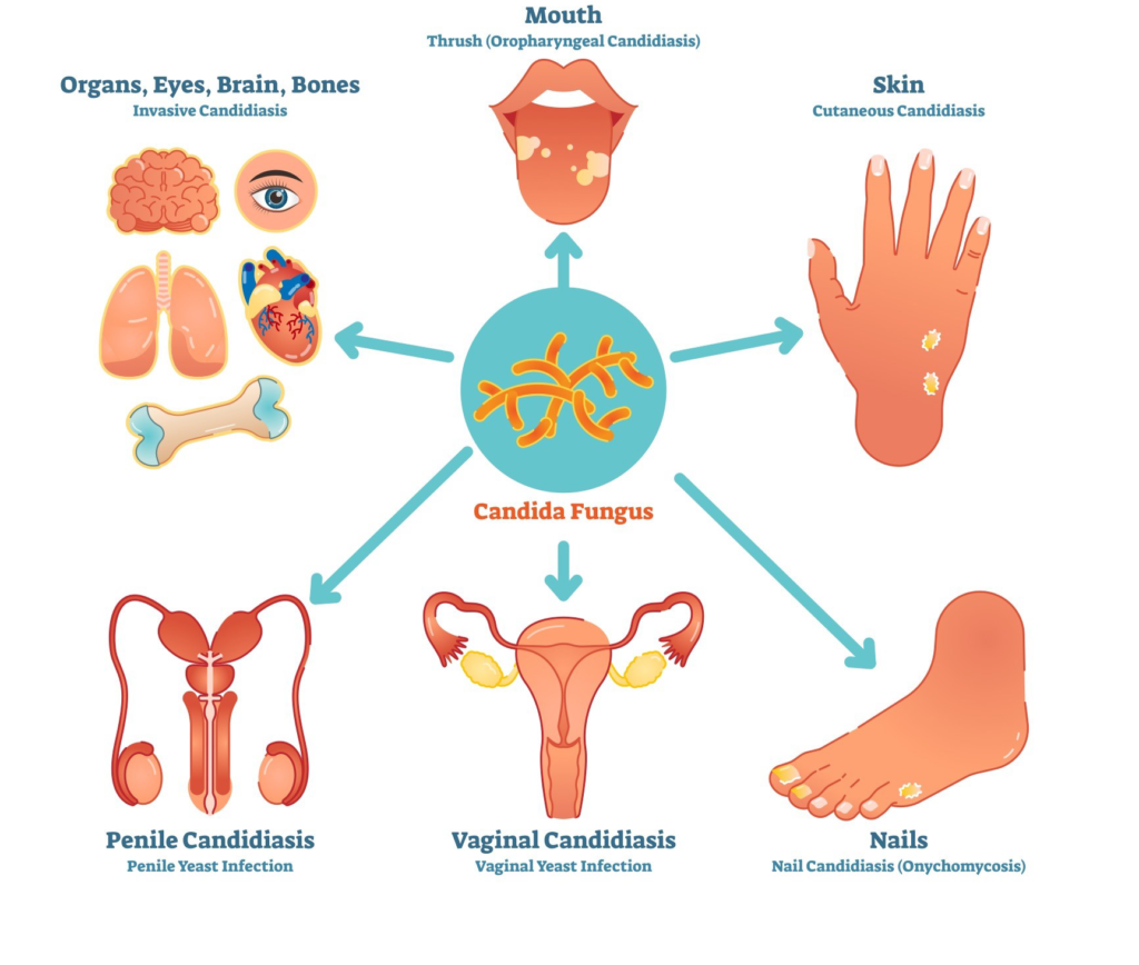 Various symptoms of Candida Overgrowth