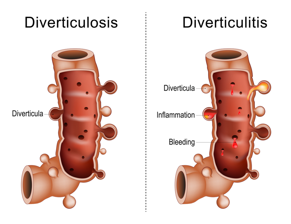 Diverticulosis and Diverticulitis comparison