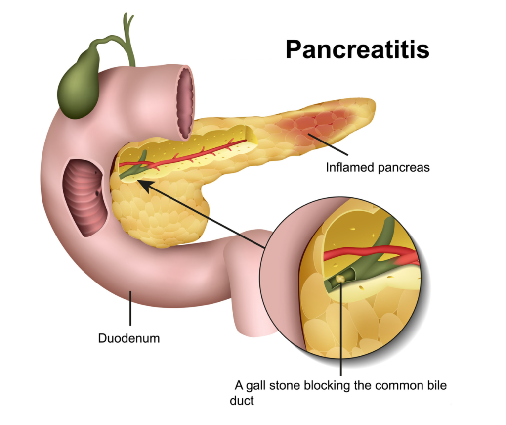 Acute Pancreatitis