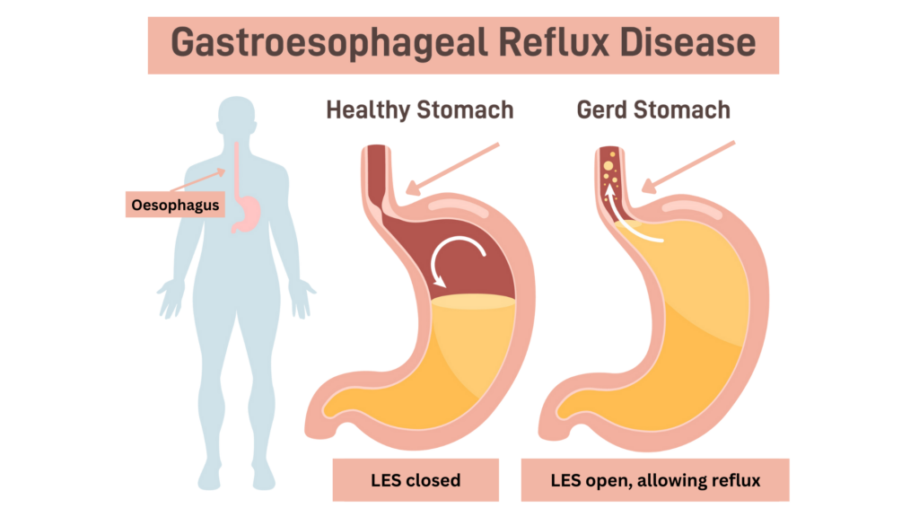 Heartburn, Acid Reflux, GERD, LES Sphincter closed and open